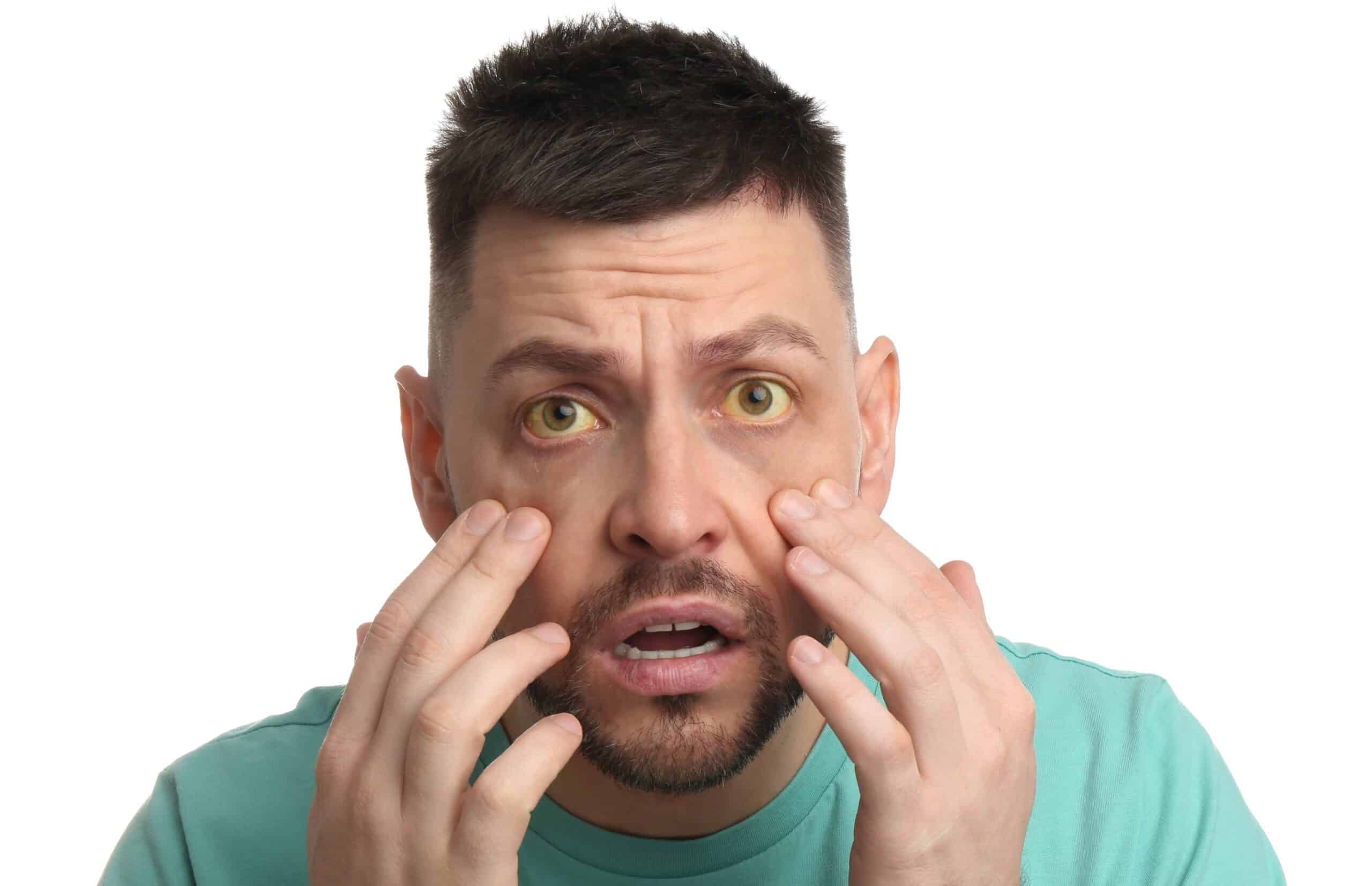 Man wondering if his yellow eyes from drinking alcohol is dangerous